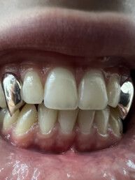 Custom Grillz Full Fangs